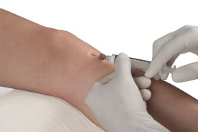 PRP Injections at Encino Orthopedics Center For Synvisc Injections